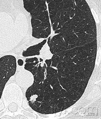 胸部解剖及常见疾病影像表现,胸部影像学基础知识