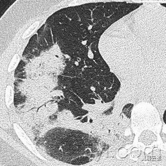 胸部解剖及常见疾病影像表现,胸部影像学基础知识