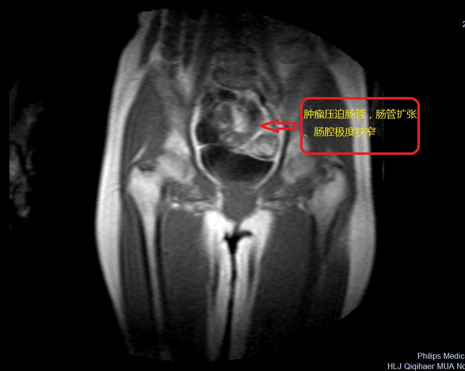 腹腔镜下直肠肿瘤切除术,腹腔镜下直肠肿瘤手术