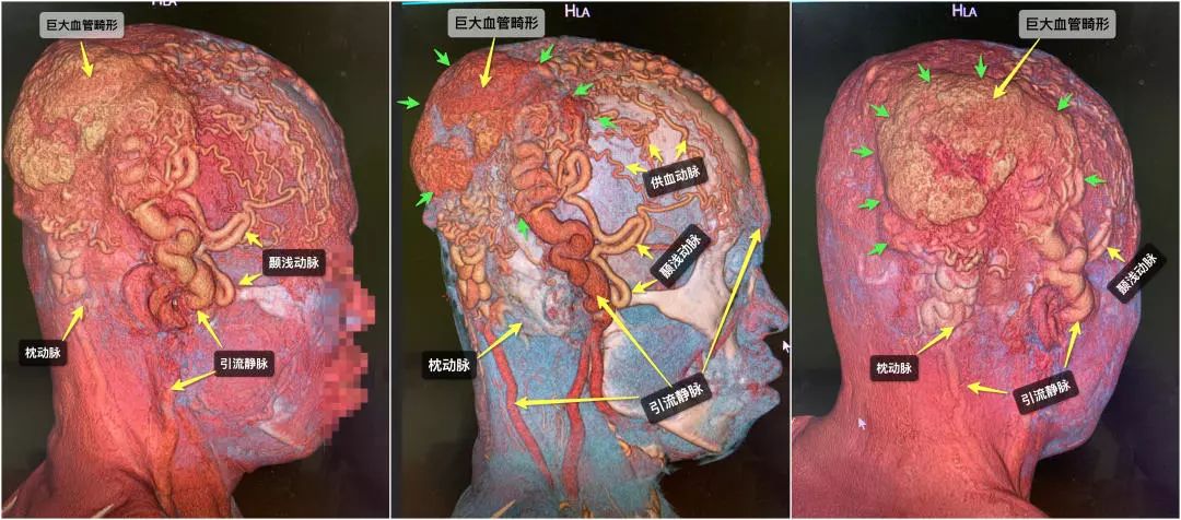 清华长庚医院混合瘤,清华长庚血管外科