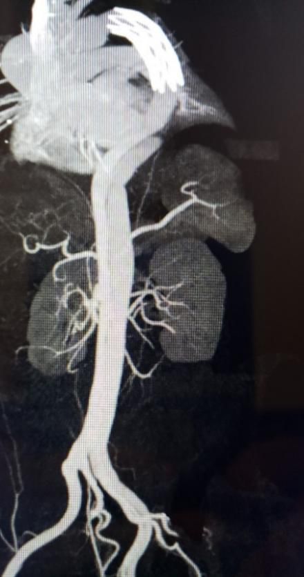 华西主动脉夹层手术怎样,再次救治急性主动脉夹层取得成功