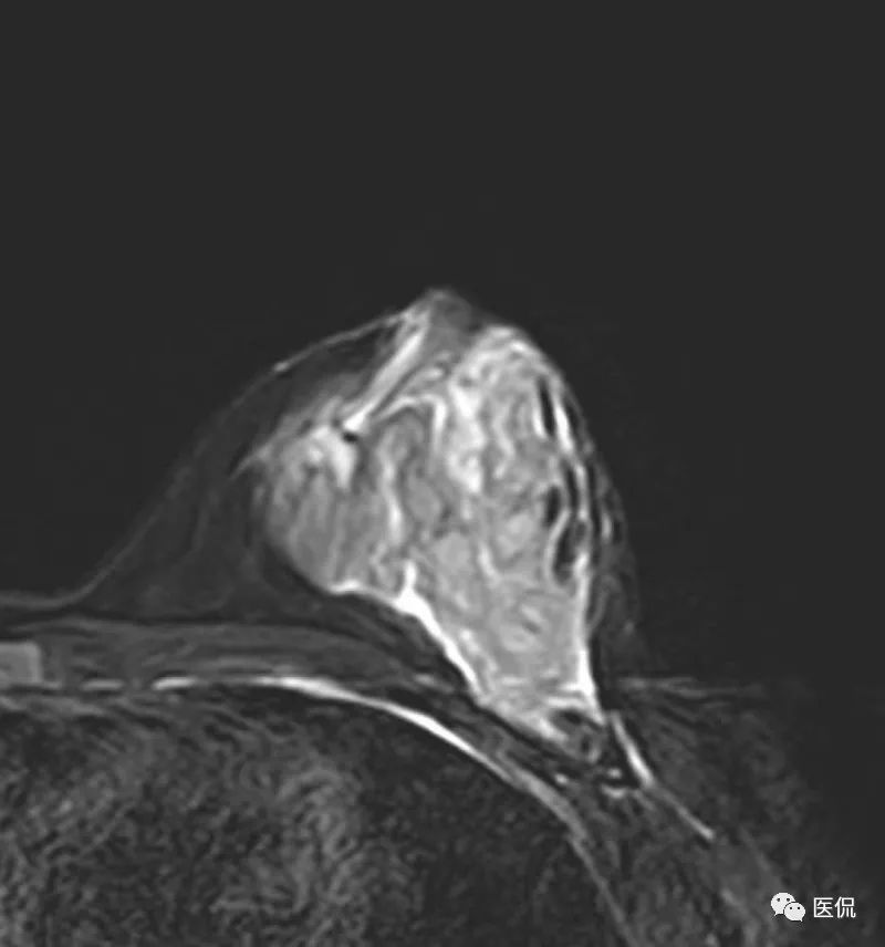 先天性乳头凹陷，MRI发现炎性病变，怎么诊断？