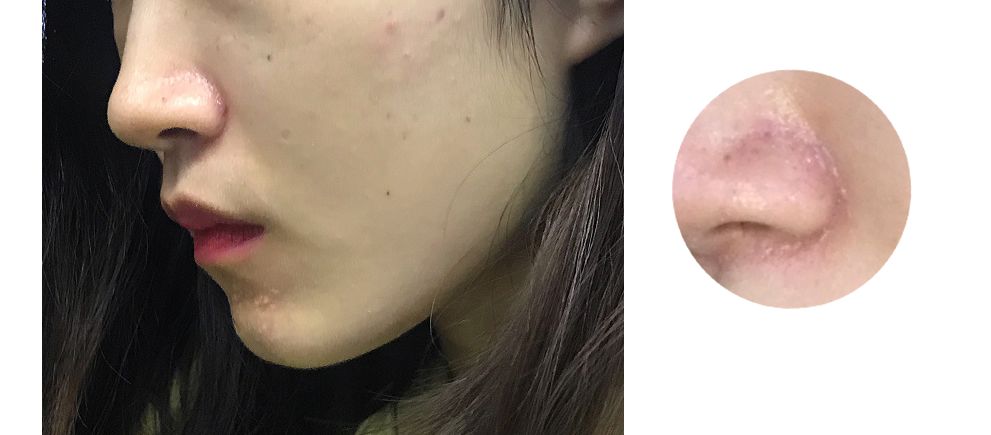 水光针副作用这么可怕,水光针有什么医疗隐患吗