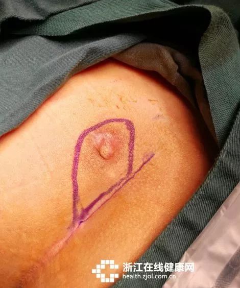 反复长大痘是有什么疾病,长了一颗很大的痘是怎么回事