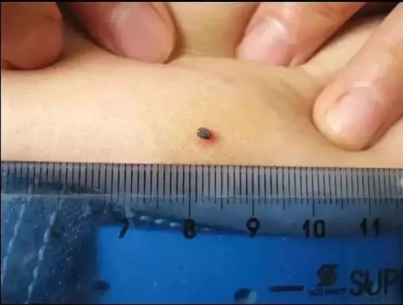 男童眼皮突然有了痣,小孩眼皮上突然出针尖大的红点