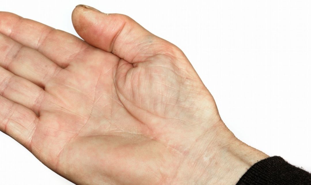 中医专家提醒手麻是大病前兆,手麻脚麻中医有一良方