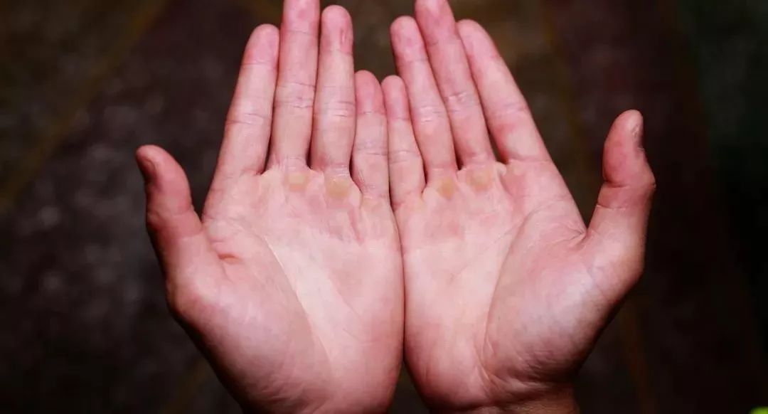 双手起满老茧的男孩,17岁男孩长了手上老茧