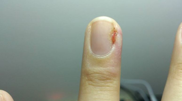 真不是吓唬你!撕“倒戗刺”可能会导致截指,你信吗?|男子拇指扎根小刺差点丢了手指