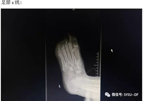 负压吸引糖尿病足的应用,负压滴灌治疗糖尿病足优势是什么