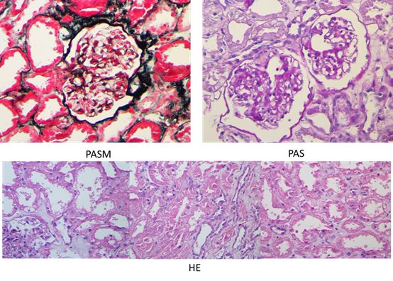 一场感冒引发的致命后果,感冒了出现血尿吃什么药
