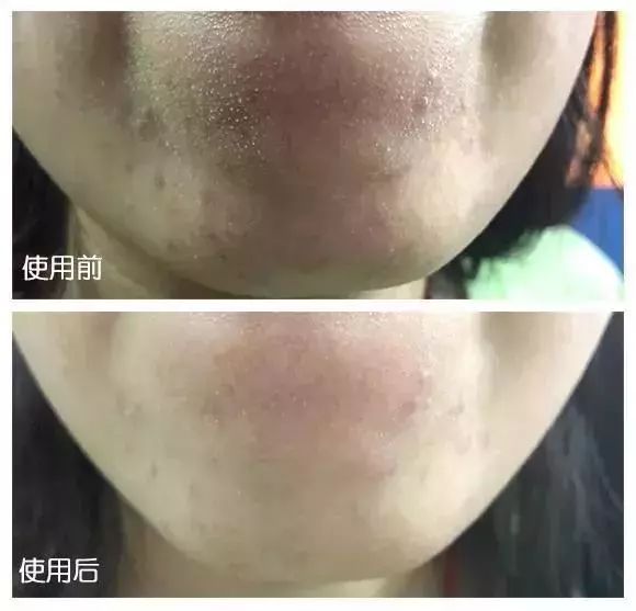 怎么把脸上的黑头清掉,去黑头推荐全脸