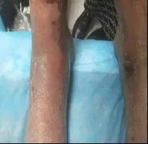 疮很常见，天疱疮你了解吗？