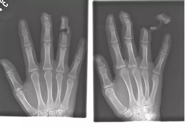 16张非常恐怖的X光照片