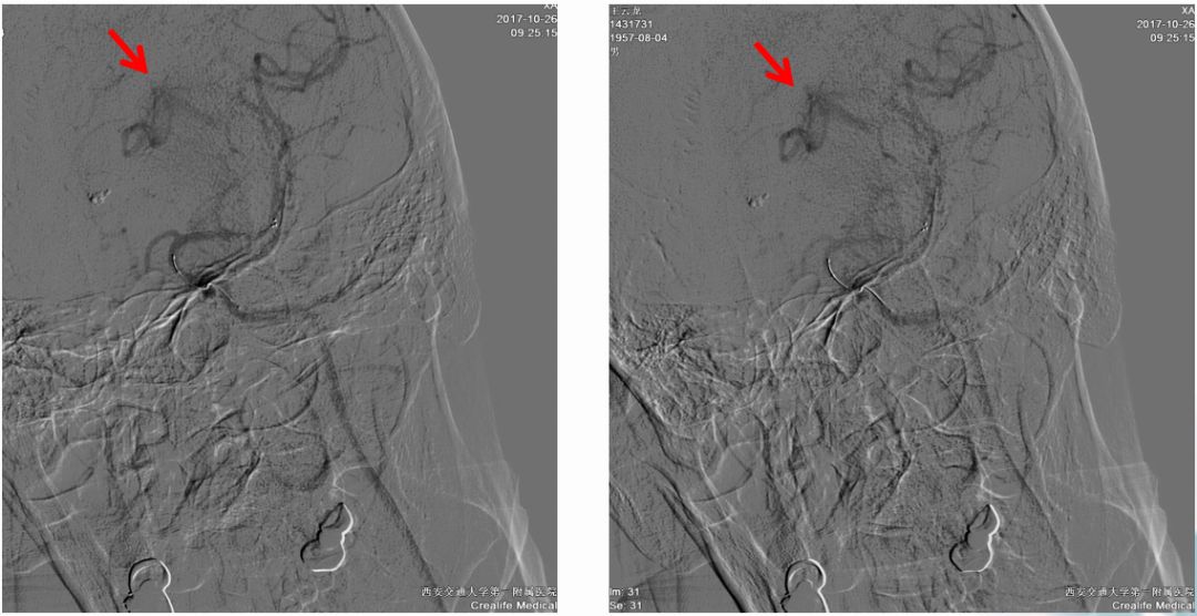 径技·例量|25期：再灌注出血—防不胜防