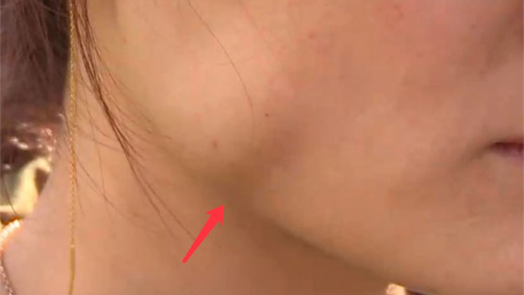 女打瘦脸针后咬肌变化图,面部注射瘦脸15天后有疙瘩