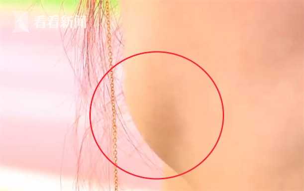 女打瘦脸针后咬肌变化图,面部注射瘦脸15天后有疙瘩