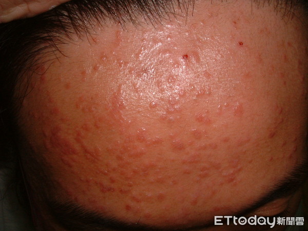 额头上扁平疣一化妆很明显,粉饼专柜试用