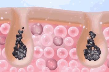 可美金箔祛痘螨虫皂,除螨皂能祛螨虫吗