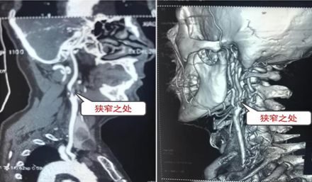 做了这个手术，肖大爷的白发变黑了……