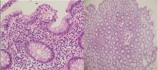 溃疡性结肠炎的诊疗过程医生笔记,溃疡性结肠炎协和