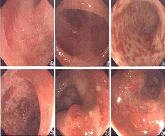 溃疡性结肠炎的诊疗过程医生笔记,溃疡性结肠炎协和