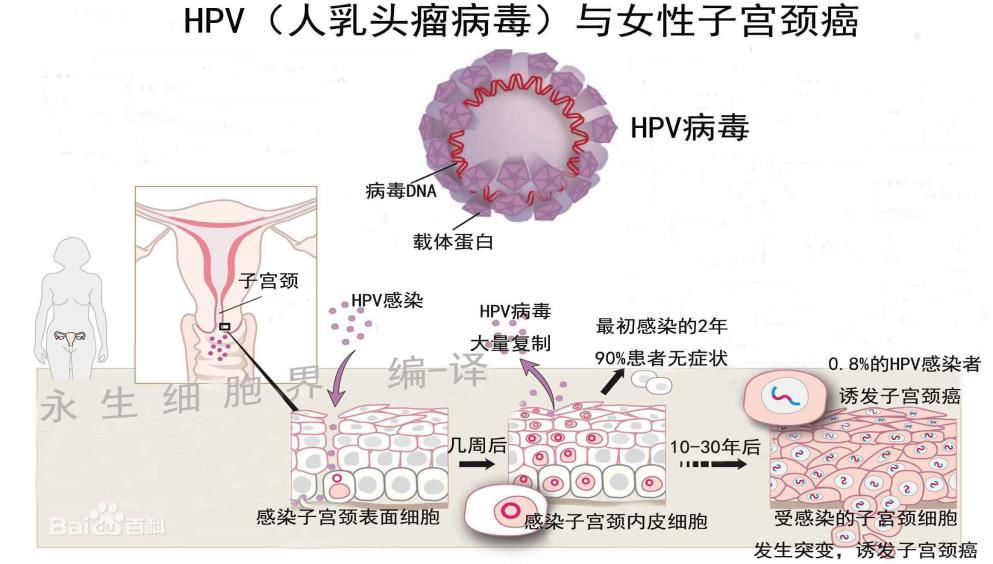 关于hpv宫颈癌您了解多少,如何知道自己得了宫颈hpv