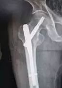 老年人股骨颈骨折康复教程,70岁股骨颈骨折保守治疗成功案例