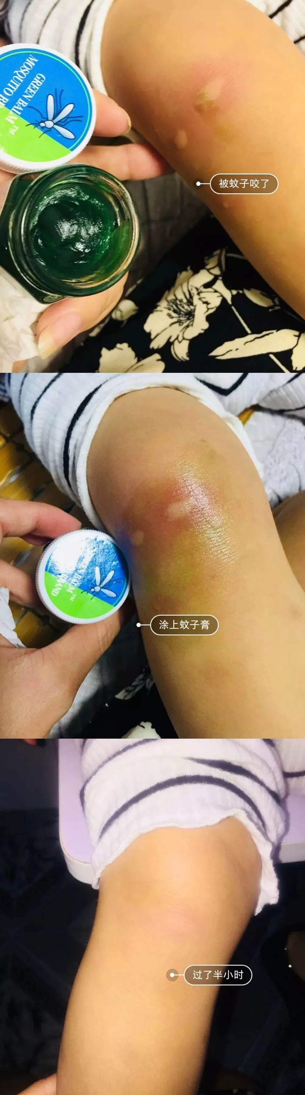 泰国蚊子咬止痒膏,防蚊虫叮咬药膏推荐泰国