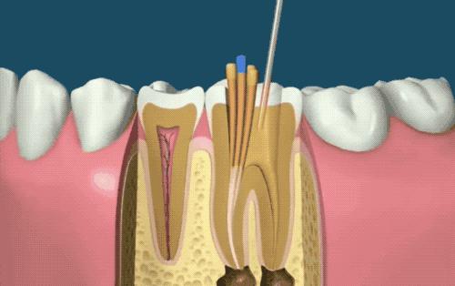 根管治疗没那么可怕,根管治疗有什么意义吗