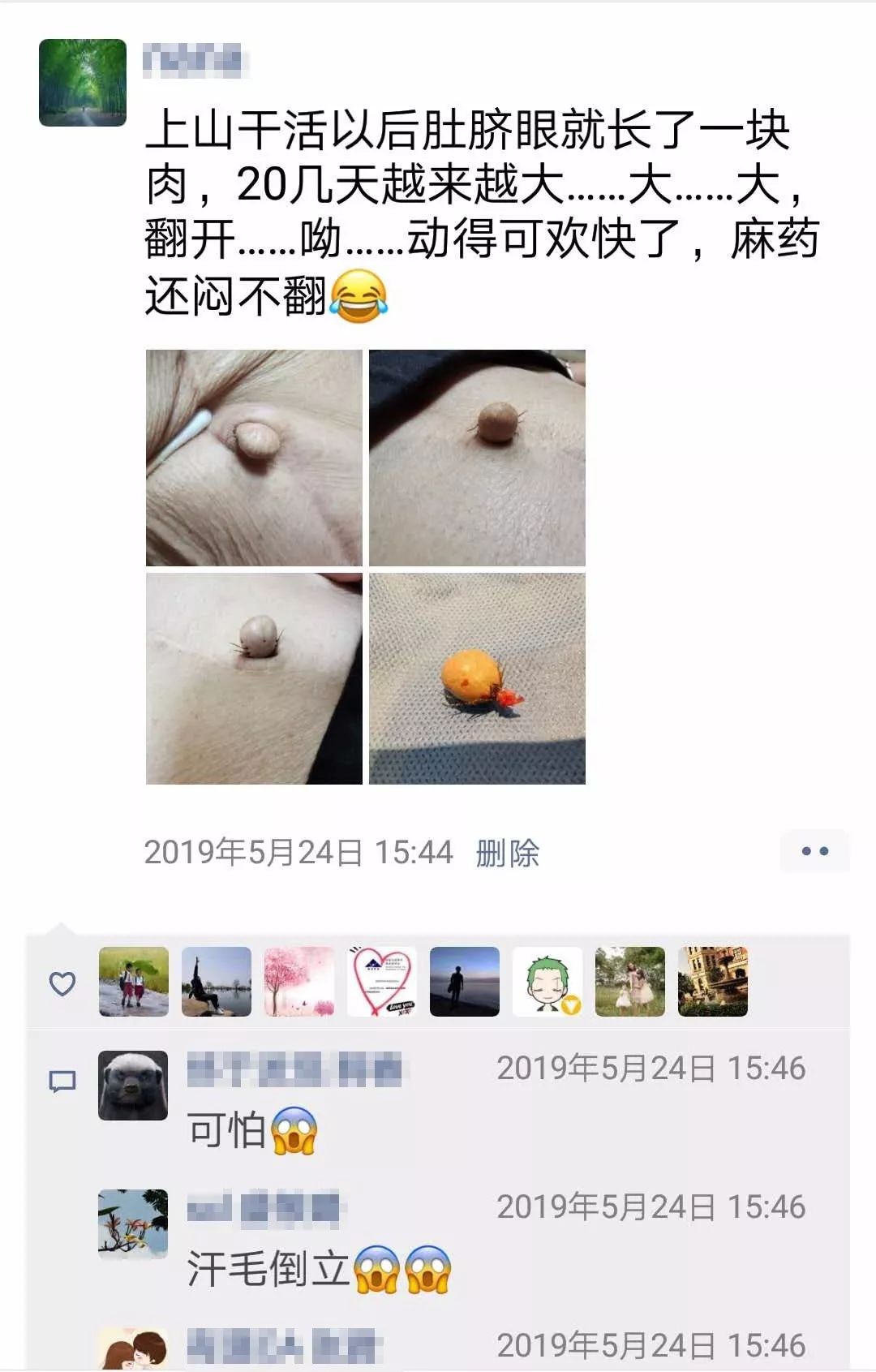 成人肚脐眼凸起肉球严重吗,成人肚脐眼凸起肉球治疗全过程