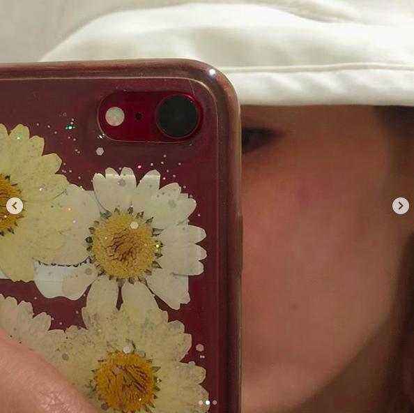 好疼！泫雅清州大学表演不慎摔倒晒受伤照颧骨磕青