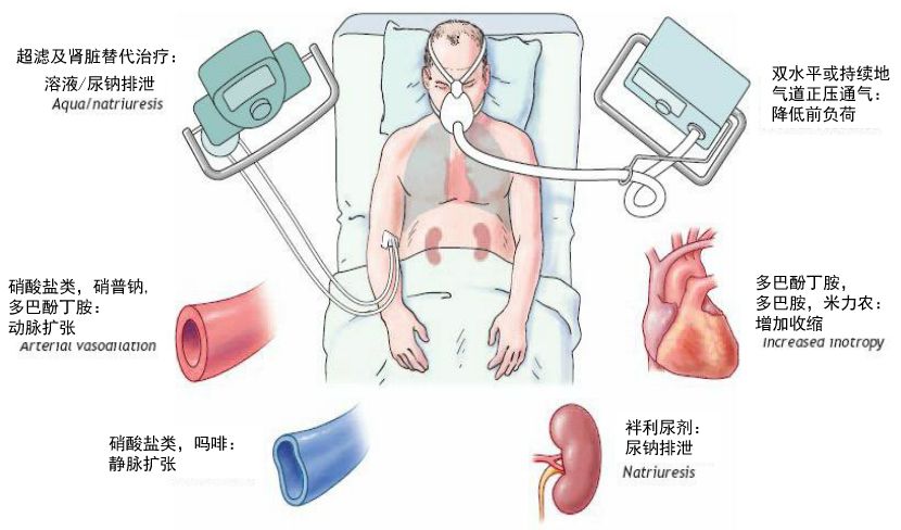 急性心衰的识别与处理,2021esc急慢性心衰诊治指南发布