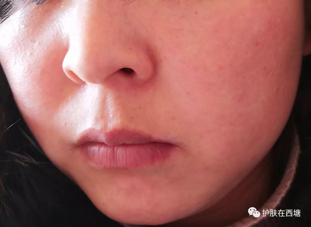 面部皮肤病科普,皮肤科普激素依赖性皮炎