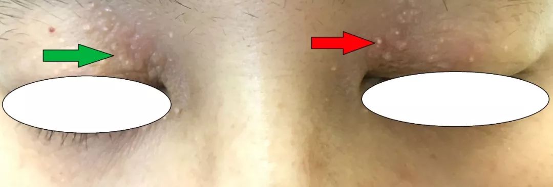 眼周细纹脂肪粒,动能素对眼周细纹有效果吗