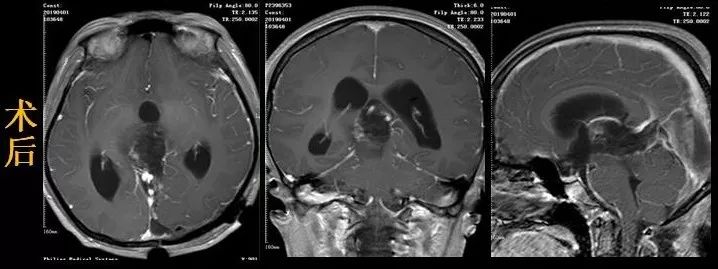 38岁女人每晚做梦是什么原因,42岁女得脑胶质瘤