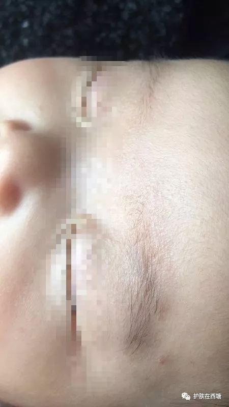 他克莫司软膏治疗脂溢性皮炎,面部皮肤脂溢性皮炎治疗方法