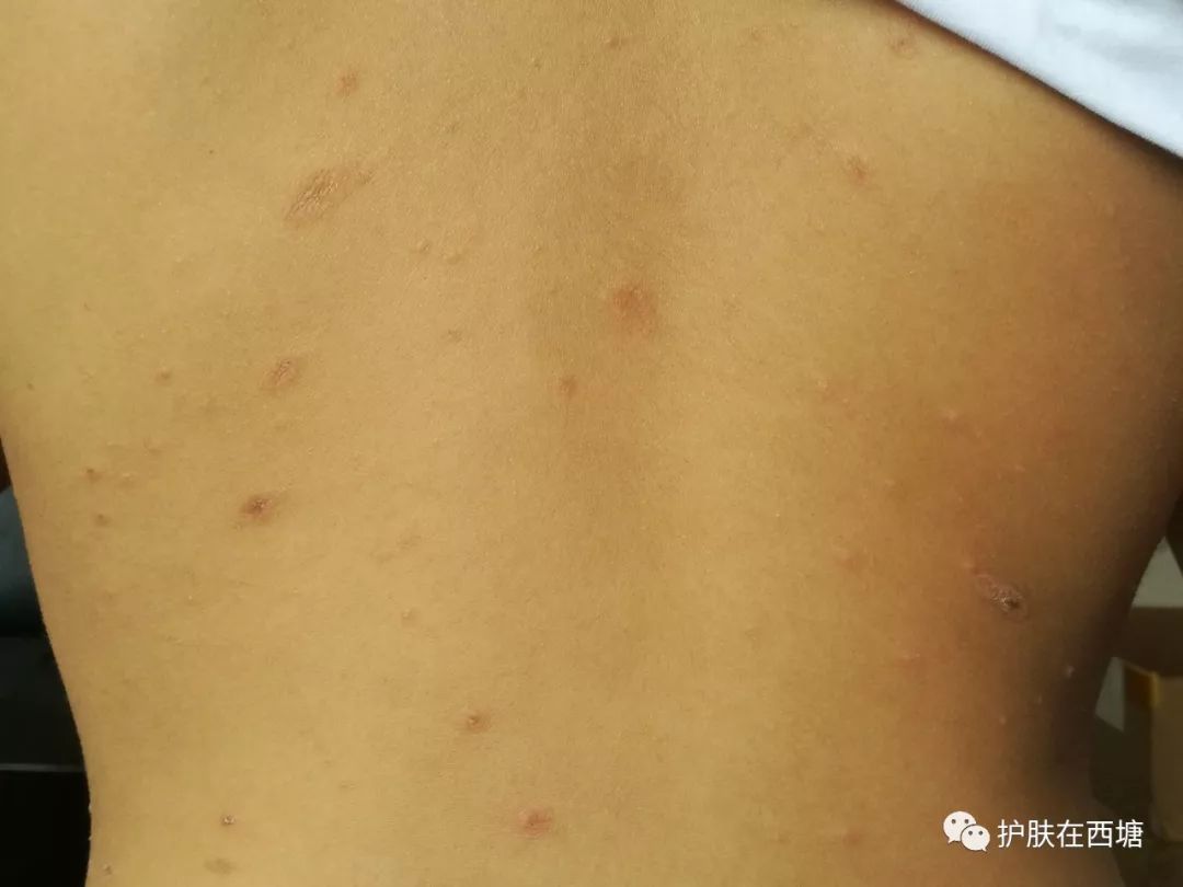 头皮脂溢性皮炎怎么彻底根除,毛囊炎和脂溢性皮炎的区别图