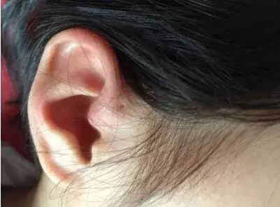 男苍金、女苍银！孩子耳朵上的苍眼到底需要不需要手术？