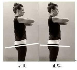 骨盆前倾医学解释,骨盆后倾引起腰痛康复