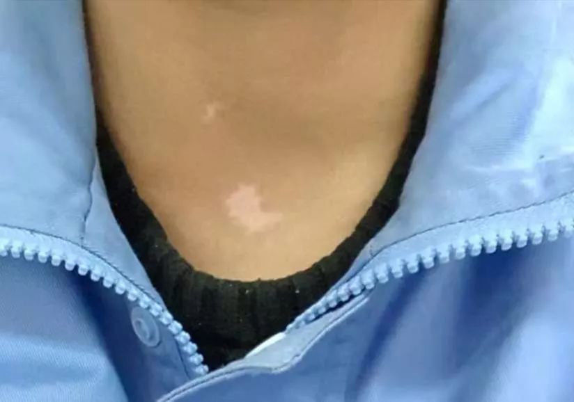 白色花斑糠疹,白色糠疹需要与哪些疾病相鉴别