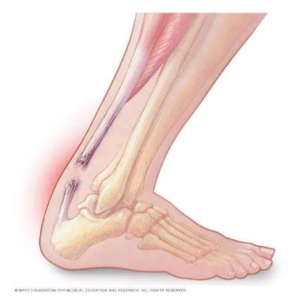 杜兰特跟腱断裂还能回到从前吗,杜兰特跟腱断裂能重回巅峰吗