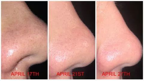 皮肤粗糙暗沉毛孔粗要做什么医美,真正改变毛孔的医美