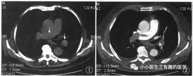ct平扫肺部能查出是哮喘吗,ct平扫肺结节准确吗