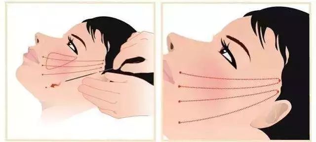 不削骨改变脸型,不削骨变脸型