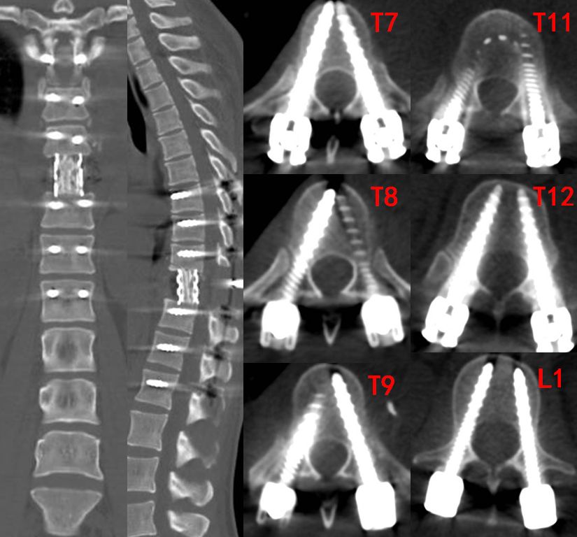 筋骨堂筋膜刀,筋骨堂整脊