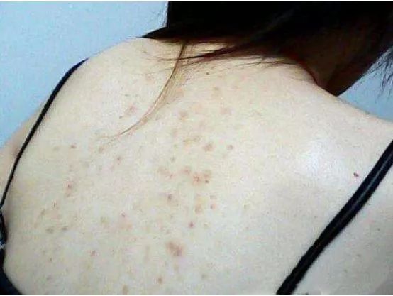 鸡皮肤永久消除,37天快速祛鸡皮肤