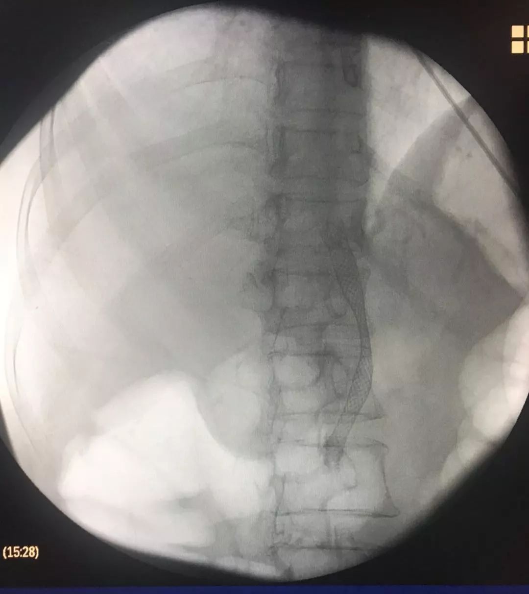 镜面人内脏移植,镜面人胆囊切除