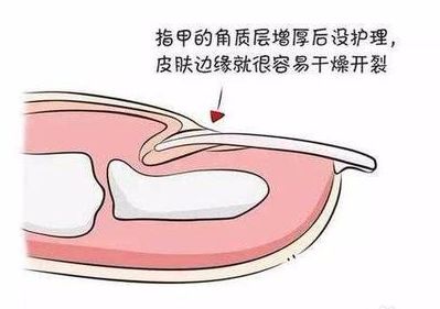 血泪教训的十个方法,手上长倒刺别乱撕这样做更靠谱