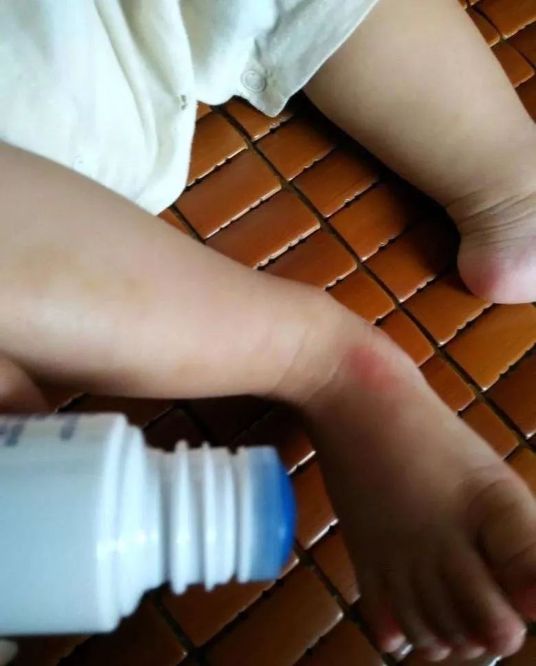 10个月大宝宝手指莫名的肿了,一岁宝宝手肿得像馒头