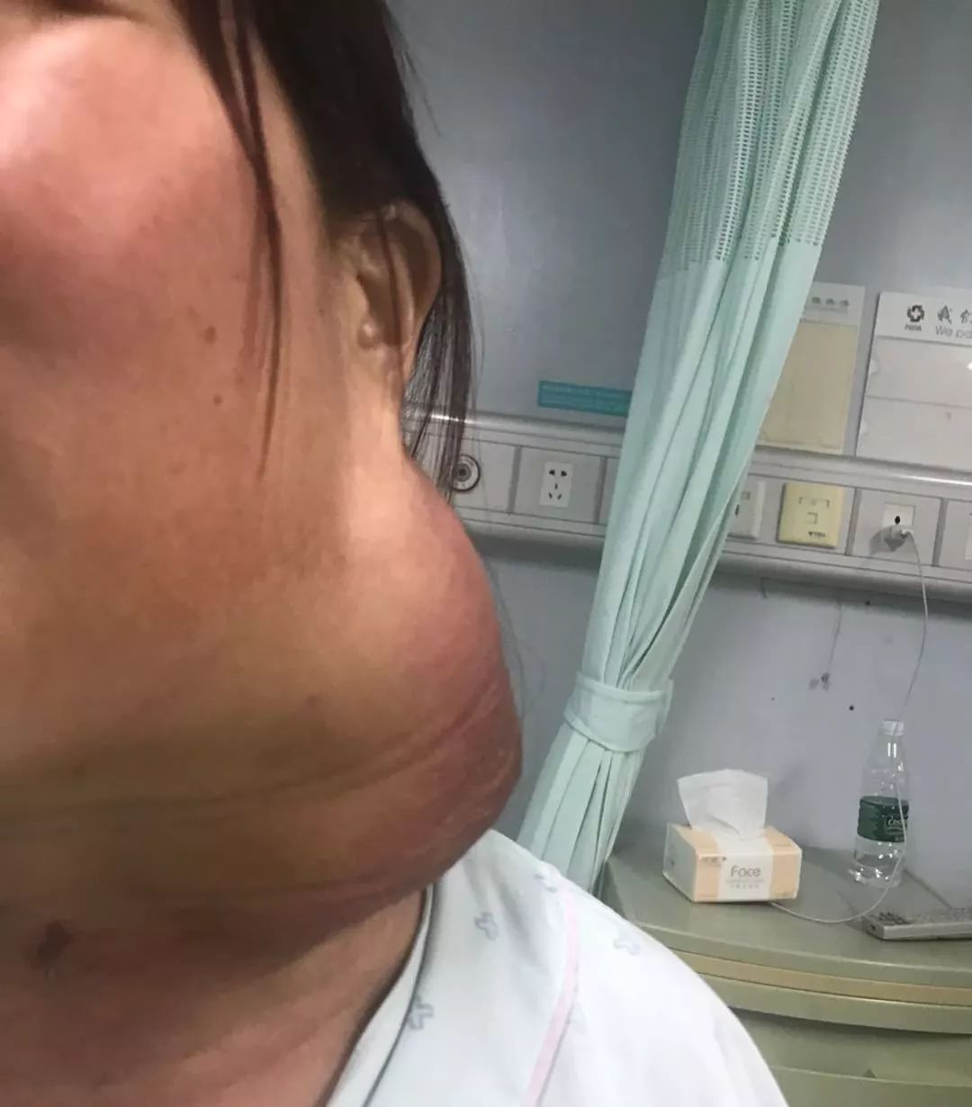 鼻咽癌脖子肿瘤太大还能治好吗,鼻咽癌转移颈部淋巴能彻底治好吗